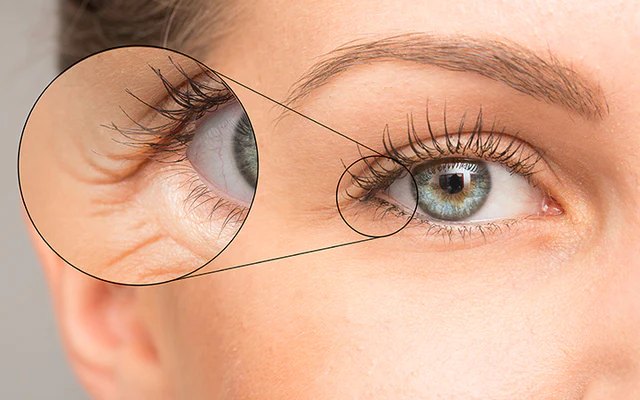 Understanding The Causes Of Under Eye Wrinkles And How To Prevent